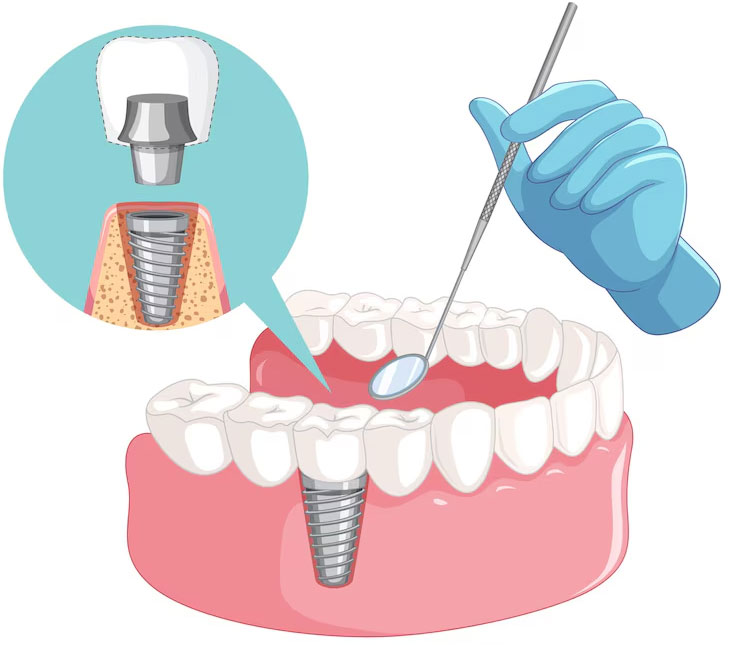 Dental Implant in Vasai, Dental Implant in Virar Dental Implant in Vasai, Dental Implant in Virar