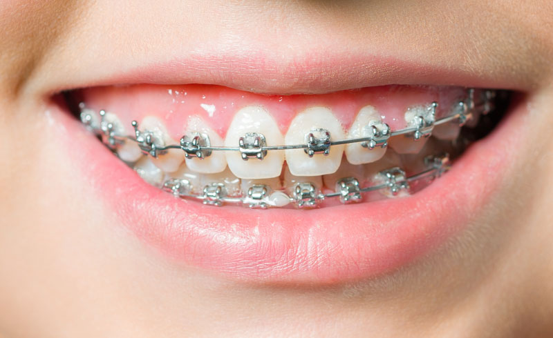 Metallic Braces in vasai