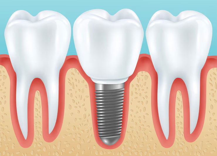 Single Tooth Implant in Vasai Virar Single Tooth Implant in Vasai Virar
